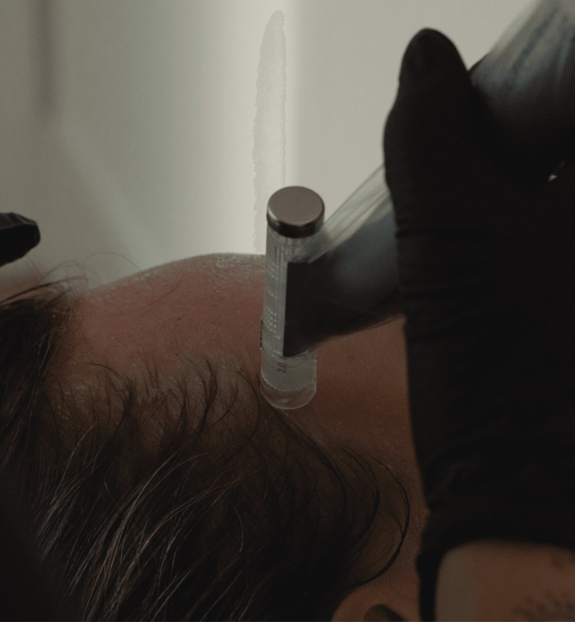 Microneedling at FaceCrime Skin Labs in Vancouver